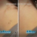 Tag Away: This Pain-Free Way to Remove Skin Tags Reviewed